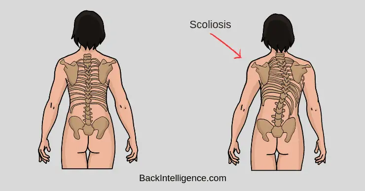 https://backintelligence.com/scoliosis-treatment/