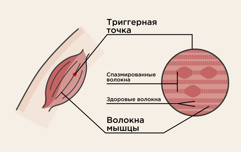 Все мышцы - набор однонаправленных клеток. если что-то среди них идет не так - легко начаться хаосу.