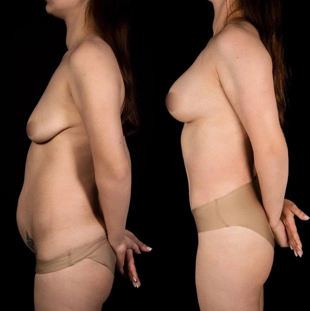 Фото пациента пластического хирурга Анны Соловьевой. До и после операции.