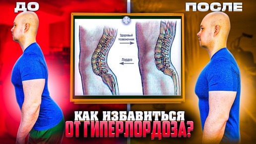 КАК ИЗБАВИТЬСЯ ОТ ГИПЕРЛОРДОЗА!?