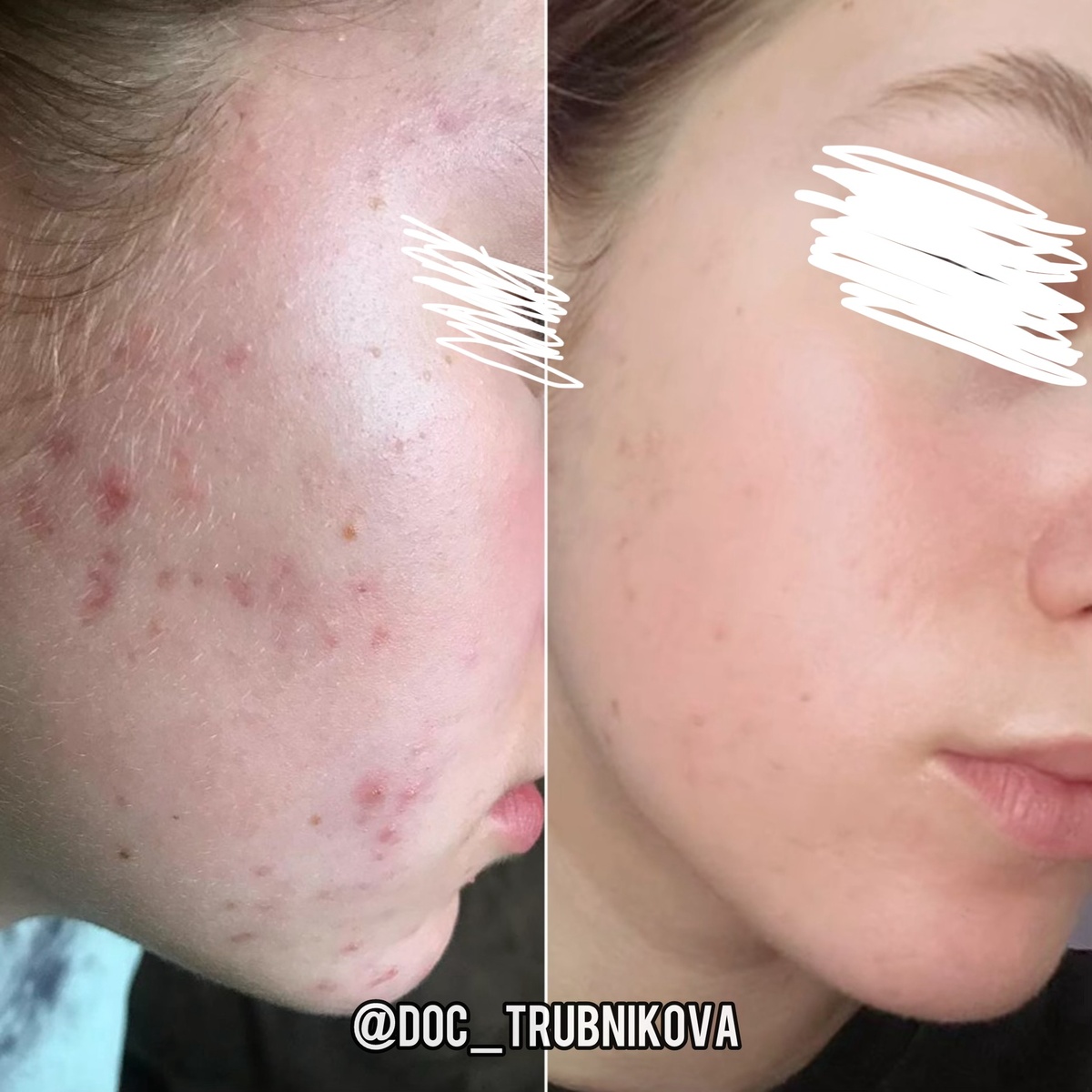 До терапии - обилие пустулезных высыпаний, пост-акне. После - чистая красивая кожа