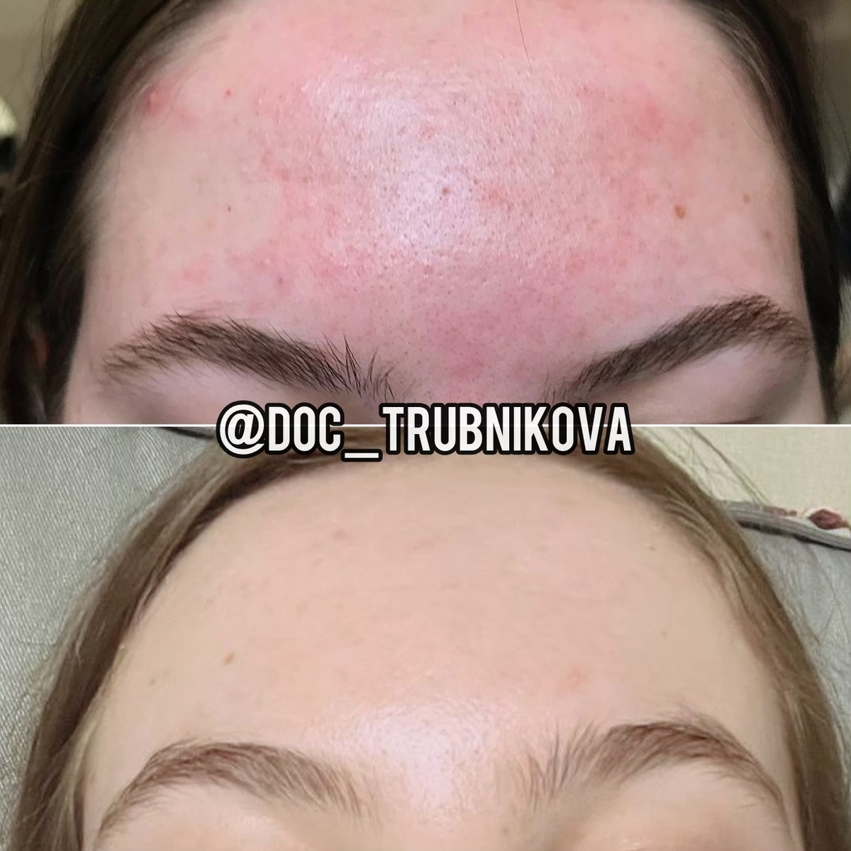 До терапии пациентка обращала внимание на ощущение приливов к коже. После - идеально ровный тон ❤️
