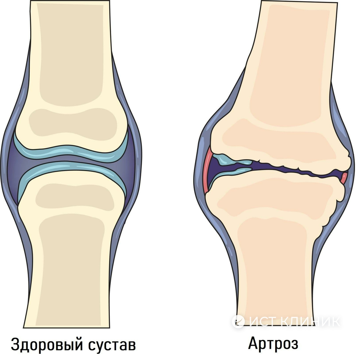 Считается, что артроз развивается при сочетании сразу нескольких факторов