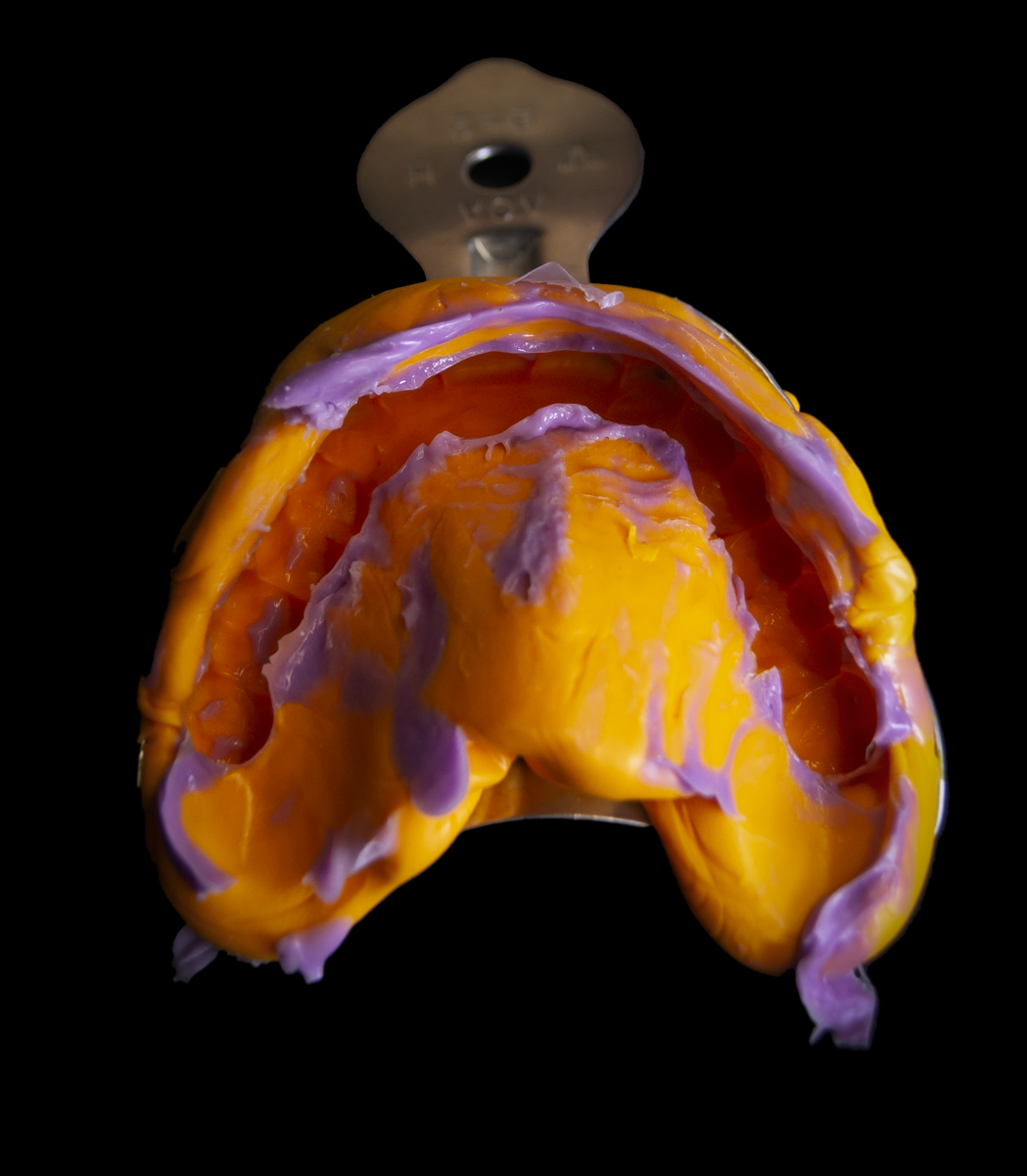 Слепок верхней челюсти.