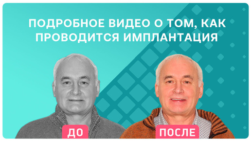 下载视频: Подробное видео о том, как проводится комплексная имплантация. Отзыв пациента клиники Smile-at-Once