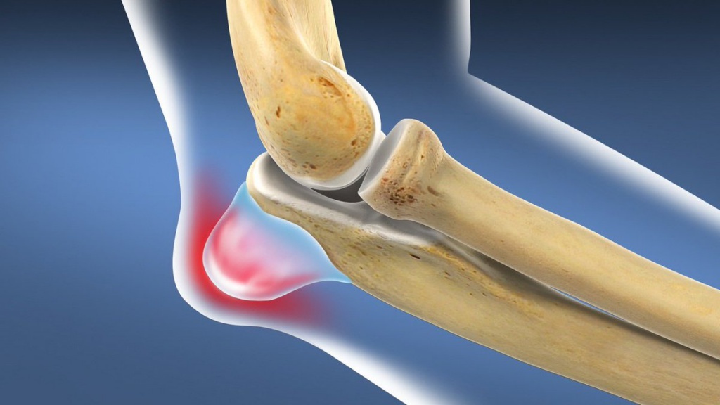 Бурсит локтевого сустава