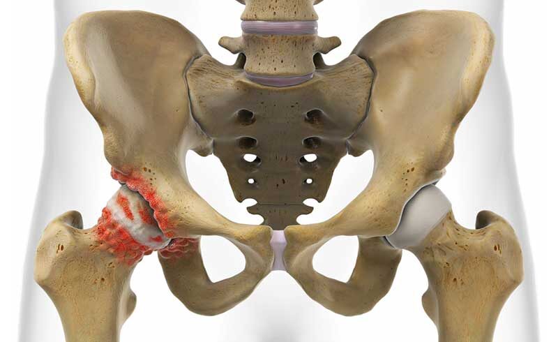 Лечебная физкультура и спорт при коксартрозе