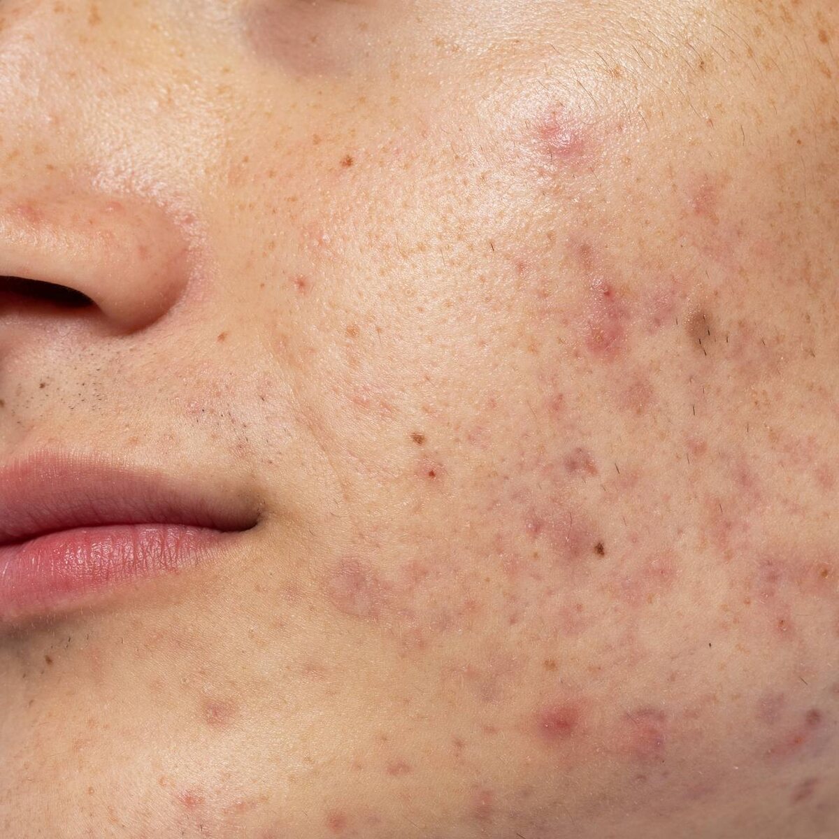 Постакне. Эффективные способы лечения