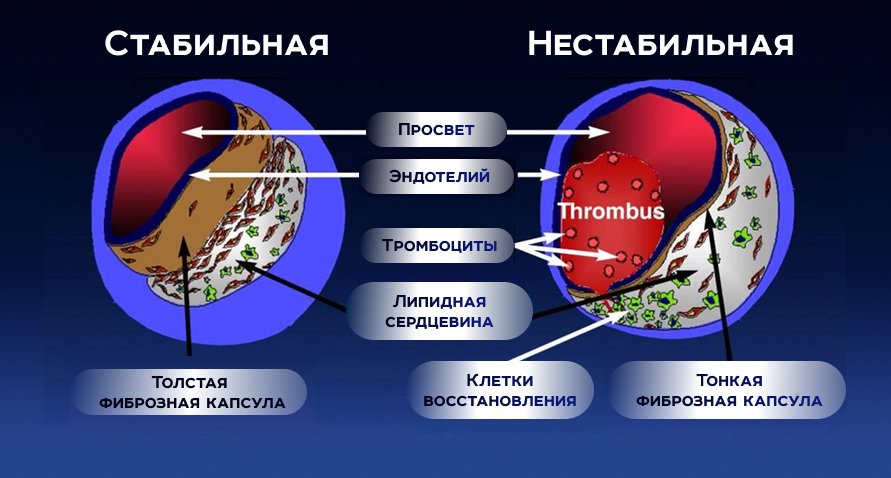 Нестабильность бляшки. Атеросклеротический процесс. Стабильная нестабильная бляшка. Стабильная и нестабильная атеросклеротическая бляшка. Нестабильная атеросклеротическая бляшка.