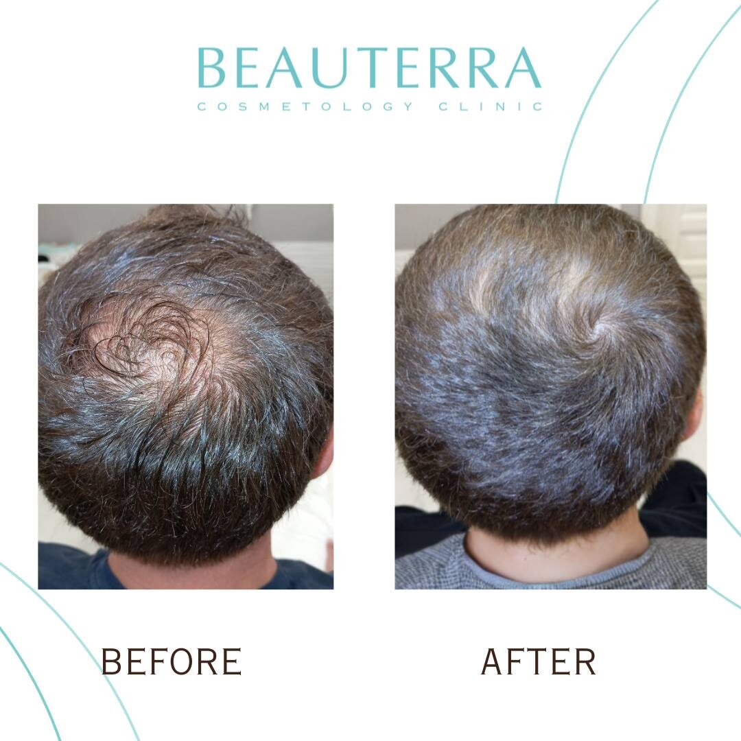 Фото до после мезотерапии головы в клинике BEAUTERRA