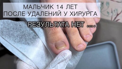 ПОЧЕМУ УДАЛЯЮТ НОГТИ? Посмотри сам и ПОКАЖИ РОДИТЕЛЯМ !