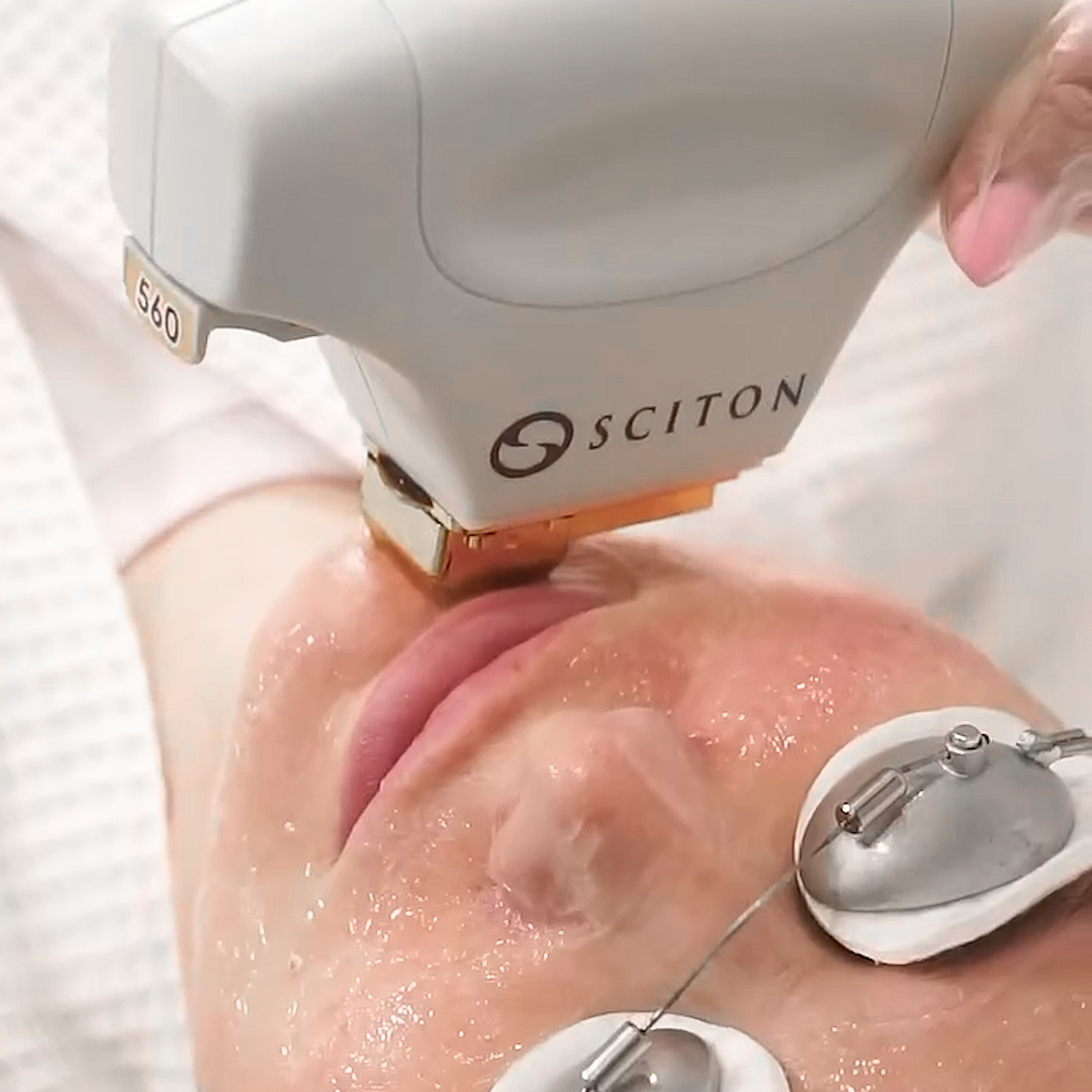 Процедура фотоомоложения на аппарате BBL