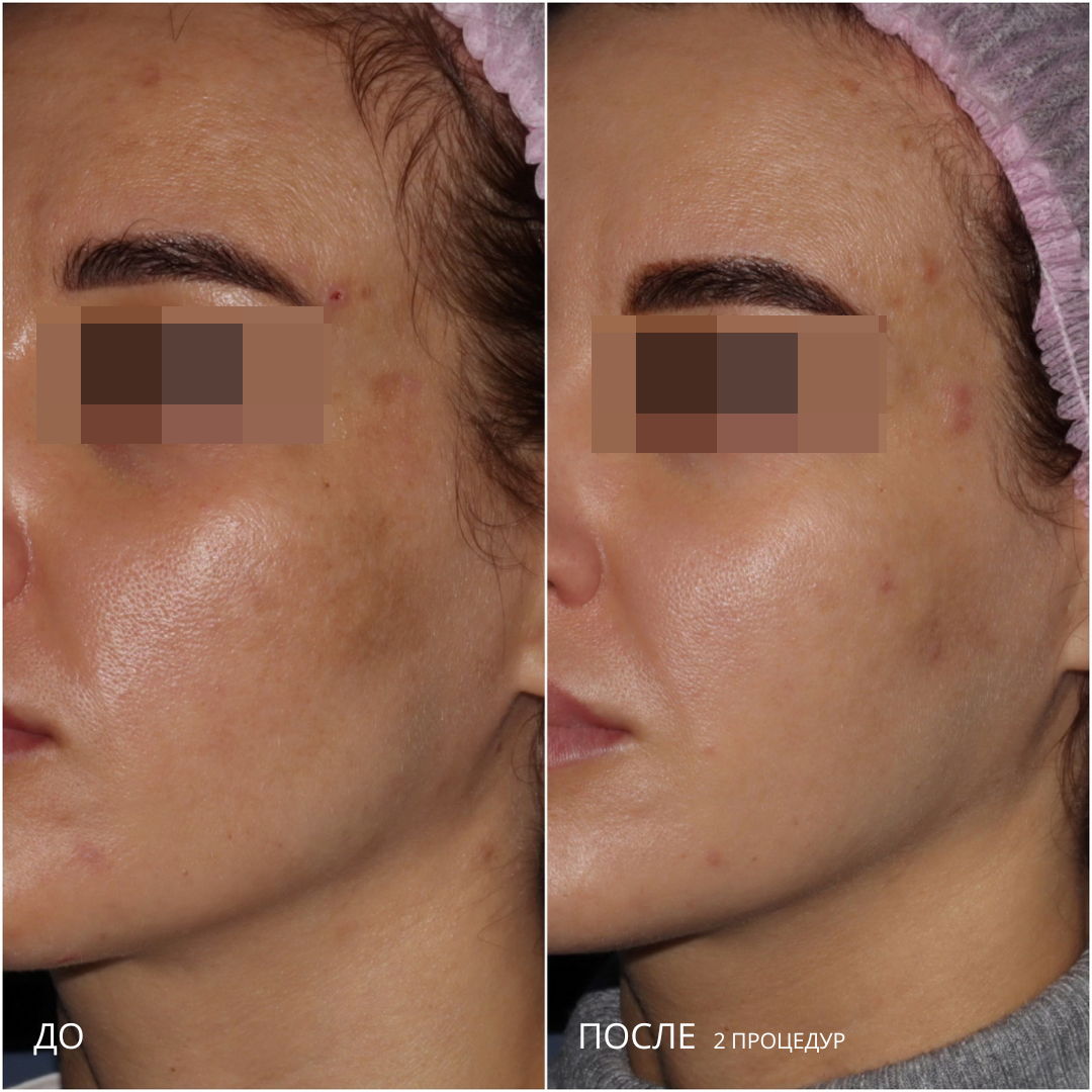 Лечение пигментации постакне