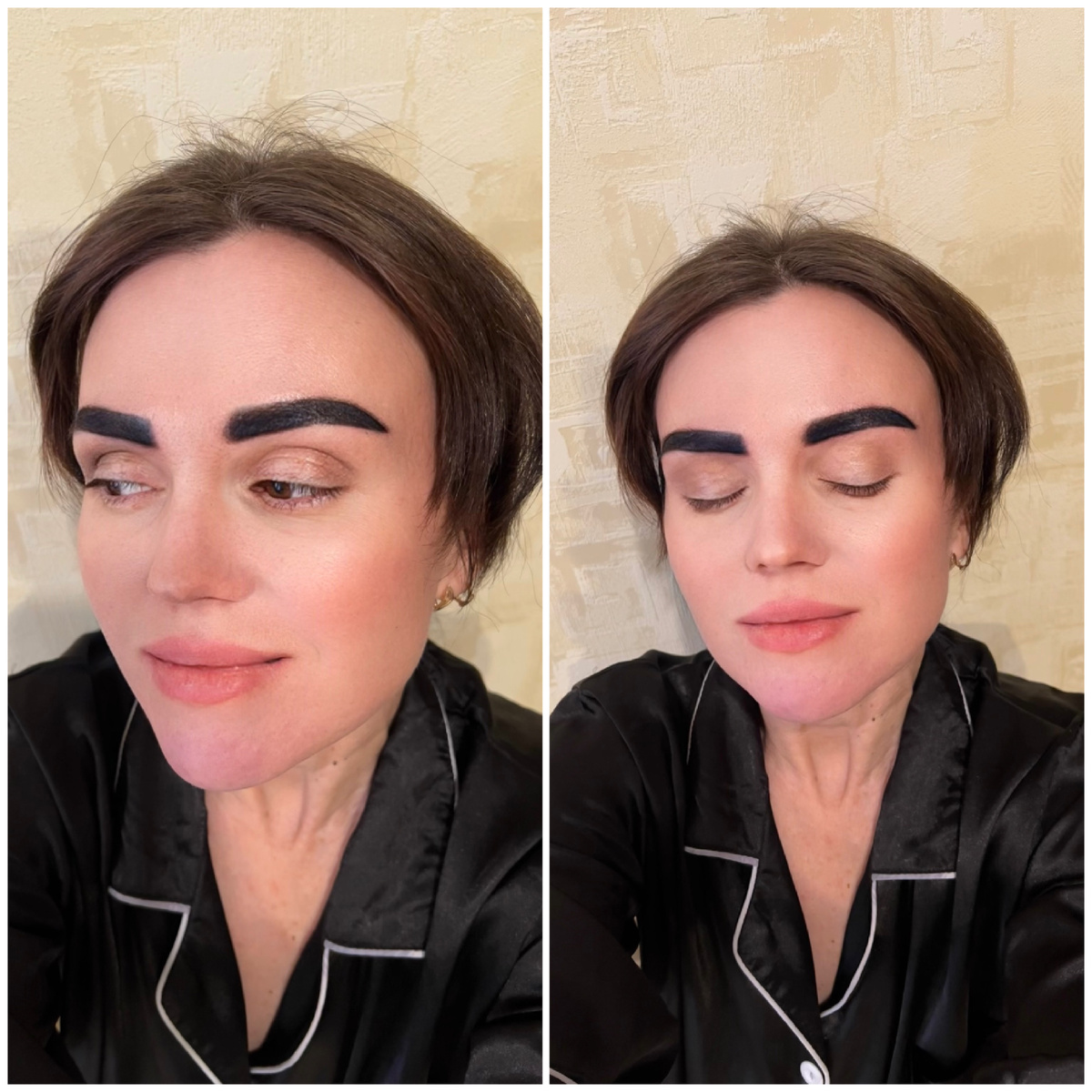 Сейчас очень яркие, блестят, но через пару дней начнут светлеть и появится корочка. Требуется несколько дней для того, чтобы прошли процессы регенерации под слоем сукровицы. По их завершению корочка начинает отпадать по кусочкам.