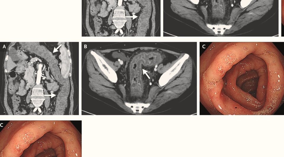   N + 1; Jian Yang and Wei Liu / The New England Journal of Medicine, 2024
