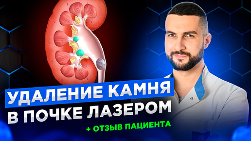 下载视频: Лазерное удаление камня почки | Отзыв пациента