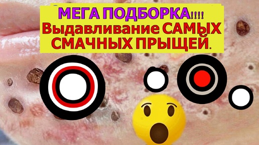 МЕГА ЗАЛИПАТЕЛЬНАЯ ПОДБОРКА Выдавливание САМЫХ СМАЧНЫХ ПРЫЩЕЙ. Крупным планом ЖИРОВИКИ, КОМЕДОНЫ и АКНЕ.