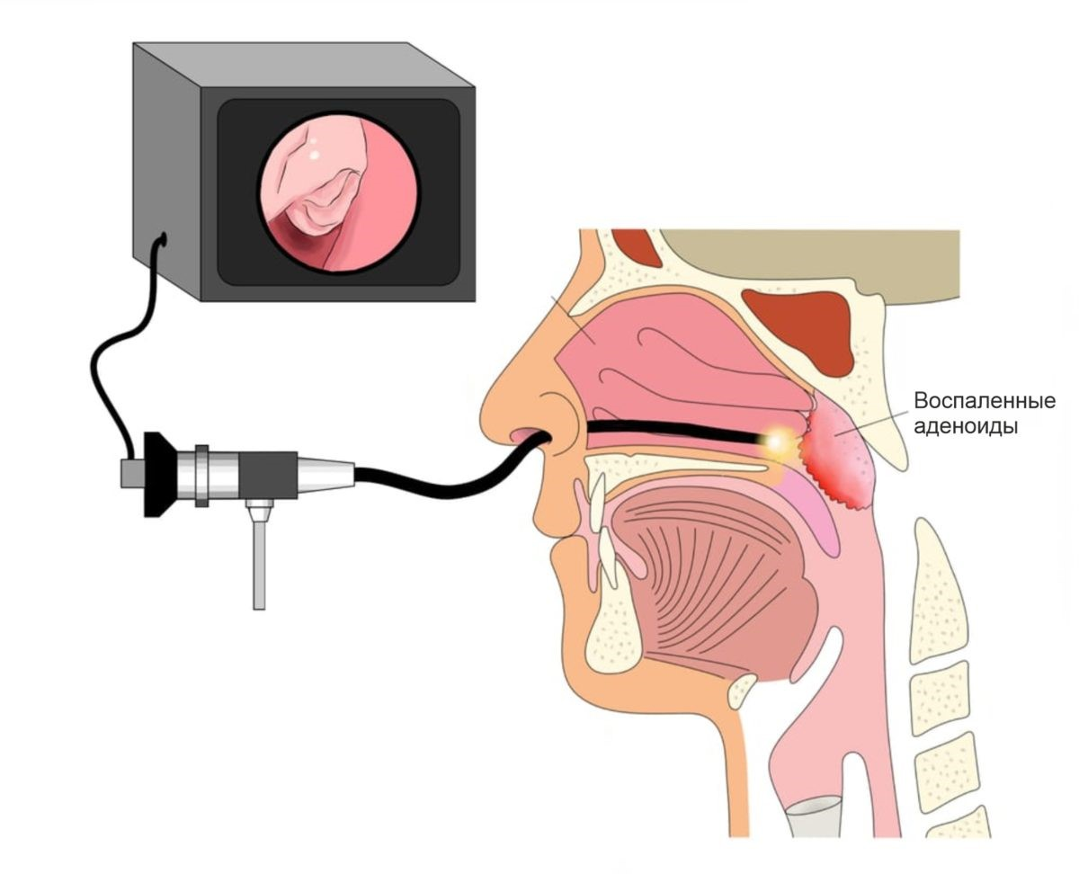 Эндоскопия носа