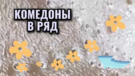 Комедоны на лице парня аж создали созвездие. Расположились в ряд и ждут косметолога. Механическая чистка кожи с залипательным эффектом