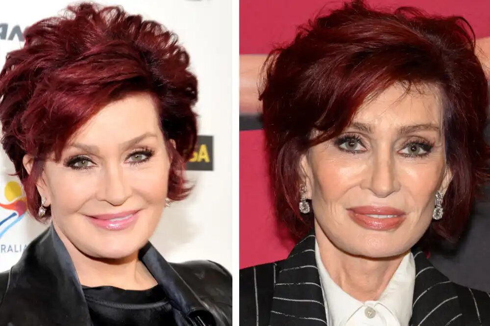 Шэрон Осборн и ее "Ozempic Face". Ozempic Face: Look Whats Happening to Hollywood": Stars Medical Channel Asia.