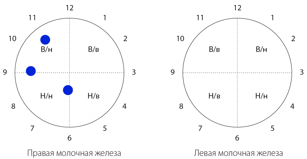 Синим отмечены места, где были фиброаденомы