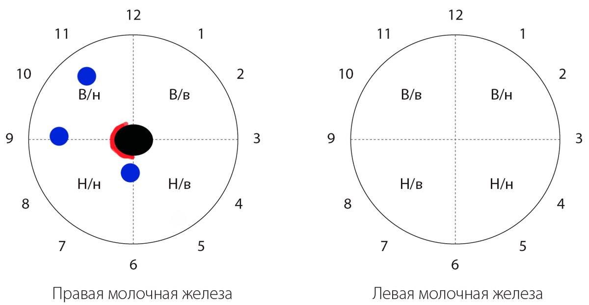 Черным отмечен сосок, красным - линия разреза, это и есть параареолярный доступ, доступ на границе ареолы соска и молочной железы.