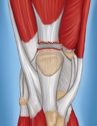 Разрыв сухожилия четырехглавой мышцы колена