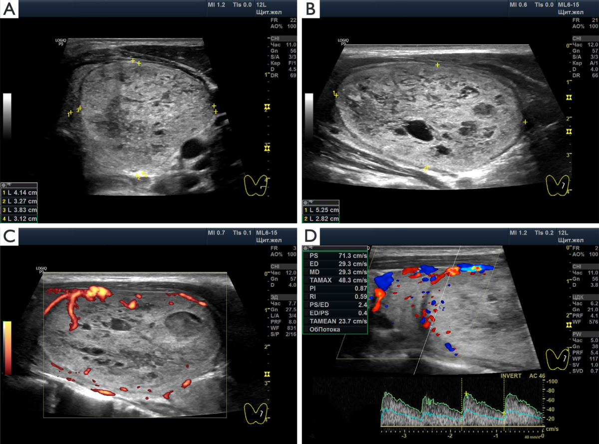 Один из 8 рисунков в статье  доктора Ушакова Stages of benign thyroid nodules: principles and ultrasound signs. Quant Imaging Med Surg. 2024 Aug 1;14(8):6108-6122. doi: 10.21037/qims-24-477.