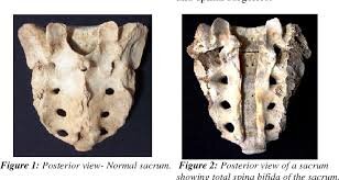 слева нормальный крестец с остистыми отростками справа spinabifida крестца, то есть открытый спиномозговой канал.
