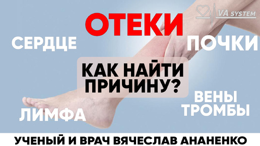 ОТЕКИ, как найти причину? Сердце, почти, лимфа, вены, тромбы