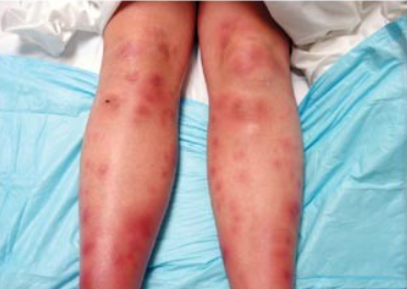 узловатая эритема у пациента с Болезнью Крона