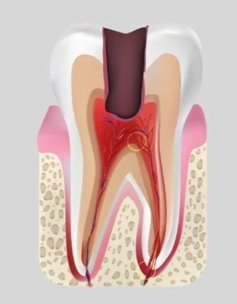 Пульпит(кариес добрался до нерва) Воспаление пульпы внутри корней зуба