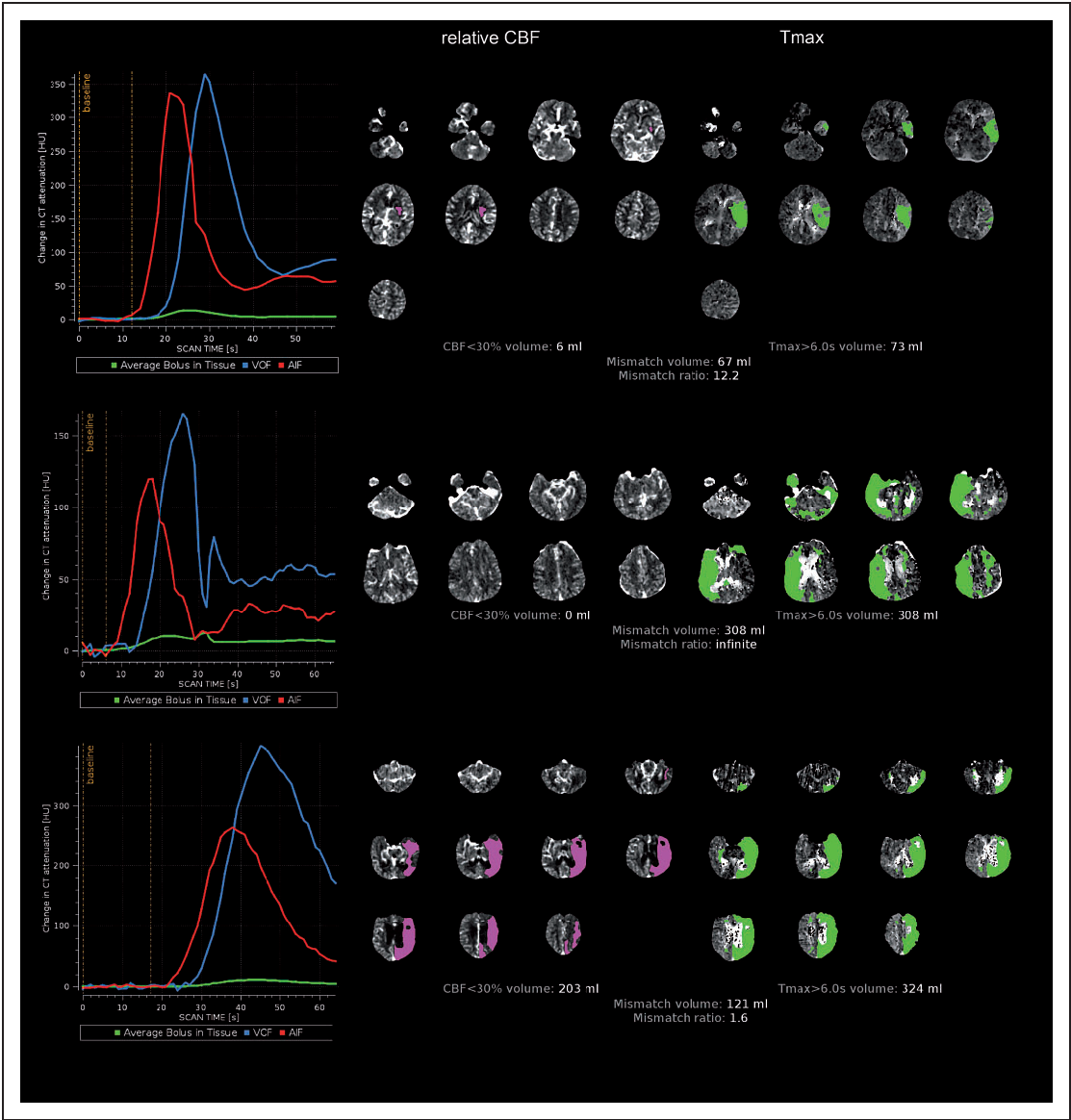 Рисунок 1. (Верхняя панель): Скан высокого качества. Функция артериального входа (AIF) и функция венозного выхода (VOF) имеют схожую форму, AIF предшествует VOF на несколько секунд, присутствует короткий предконтрастный базовый уровень (5–10 с), и восходящий и нисходящий склоны VOF полностью захвачены. Карты CBF и Tmax демонстрируют анатомически правдоподобные односторонние поражения без артефактов. (Средняя панель): Скан с движением. И AIF, и VOF имеют неровный вид, что указывает на движение. Карта CBF не показывает поражений ниже порога 30%. Карта Tmax содержит двусторонние поражения, что указывает на артефакты. Хотя у пациента, вероятно, есть ткань с повышенным риском, рассчитанный объем несоответствия (mismatch) завышен по сравнению с реальным объемом несоответствия. (Нижняя панель): Кривые AIF и VOF указывают на позднее поступление и широкий болюс контраста. Прохождение контраста не полностью зафиксировано во время 60-секундного сканирования, что видно по «усеченной» VOF (сканирование заканчивается на нисходящем склоне VOF). Это может привести к ложным результатам при оценке объемов Tmax и CBF, поэтому их следует интерпретировать с осторожностью.