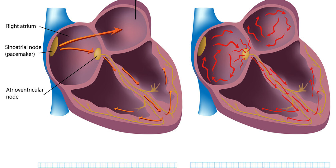 Не игнорируйте эти 6 скрытых признаков фибрилляции предсердий: предупреждение кардиологов