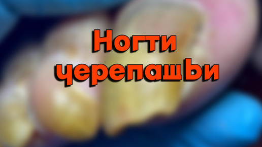 Сделали крутой педикюр и убрали черный пораже...ый