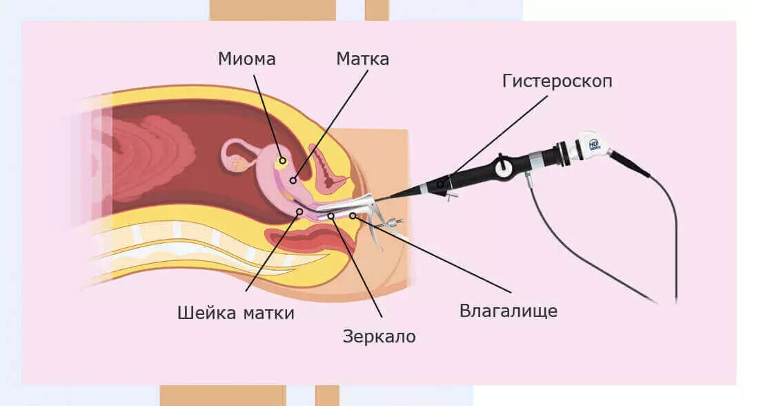 Гистероскопия матки