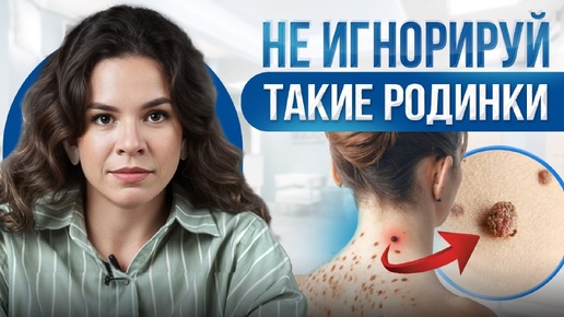 Чем опасны родинки Проверь свои прямо сейчас! НЕ ИГНОРИРУЙ ТАКИЕ РОДИНКИ