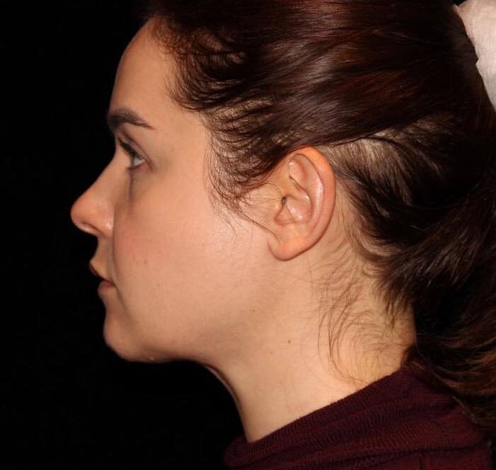 Выполнена медиальная платизмопластика.