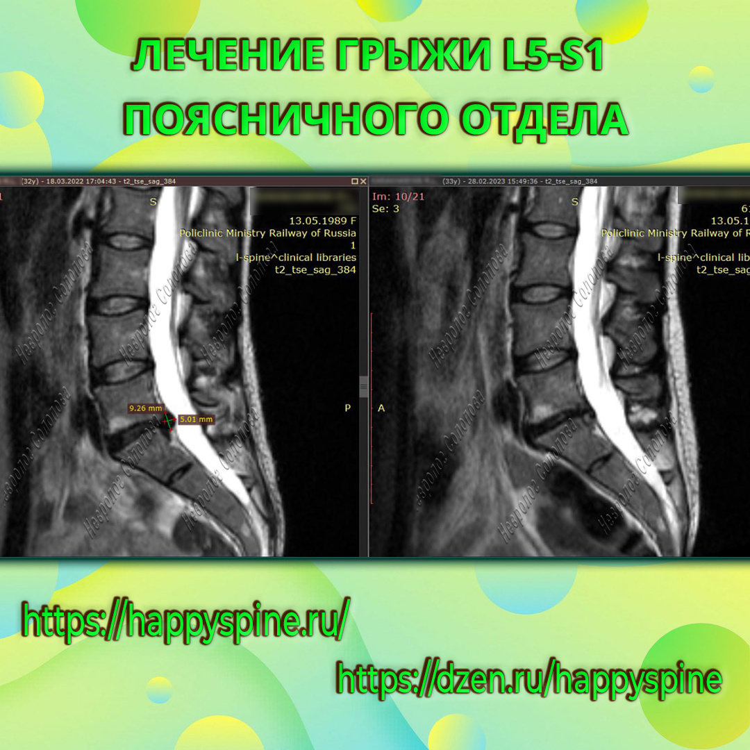 Тренировка в зале при грыже поясничного отдела