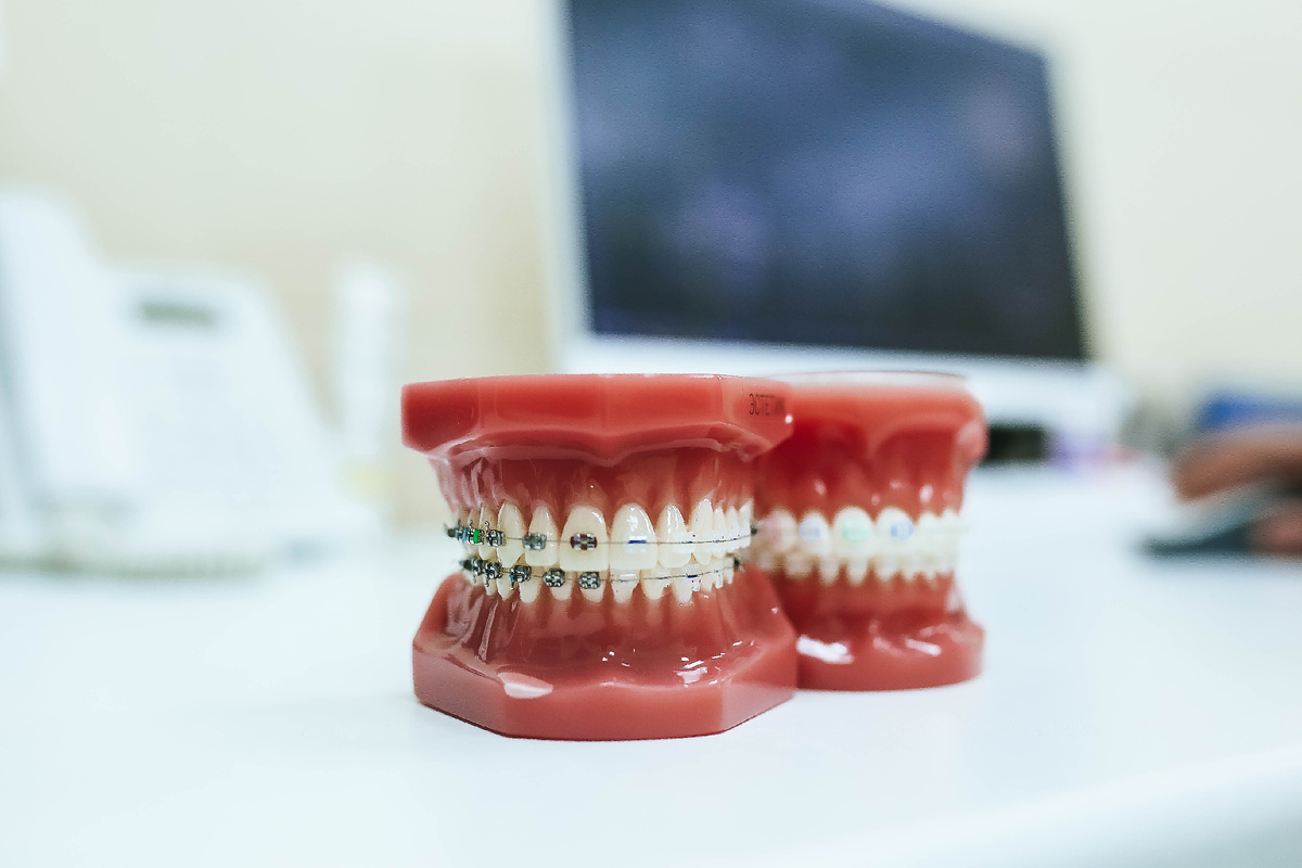 При нормальном прикусе верхние зубы должны касаться нижних и перекрывать их на 1/3.