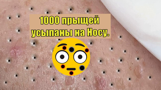 1000 прыщей усыпаны на Носу. Косметолог давит акне комедоны на лице.