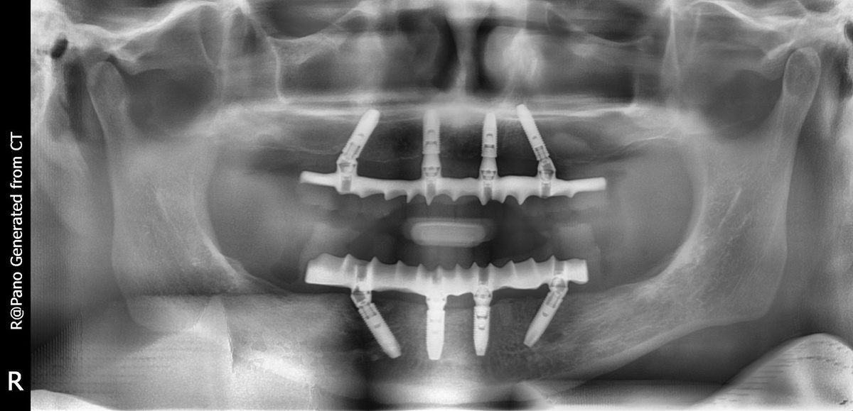 На снимке видно, что зубные импланты стоят под углом для обеспечения лучшей стабилизации даже при сильной атрофии кости