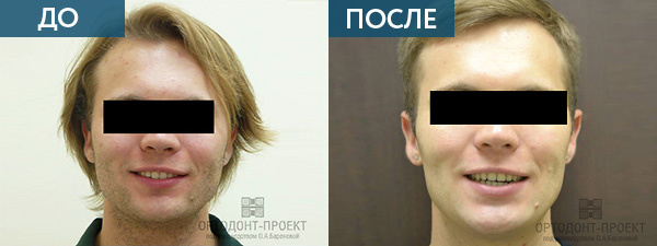 Исправление прикуса у взрослого пациента ДО и ПОСЛЕ
