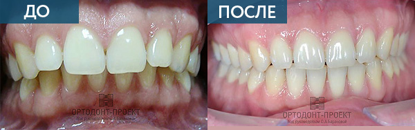Исправление прикуса у взрослого пациента ДО и ПОСЛЕ