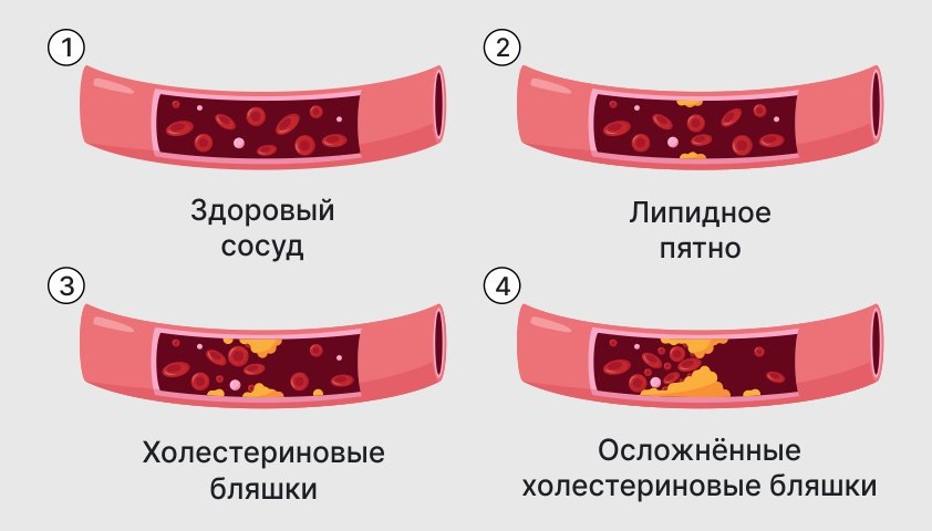 
Стадии атеросклероза