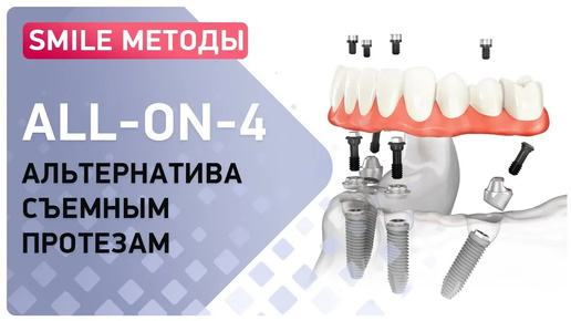 Video herunterladen: Вы тоже носите съемные протезы? Альтернатива ЕСТЬ! All-on-4 или имплантация за 1 день