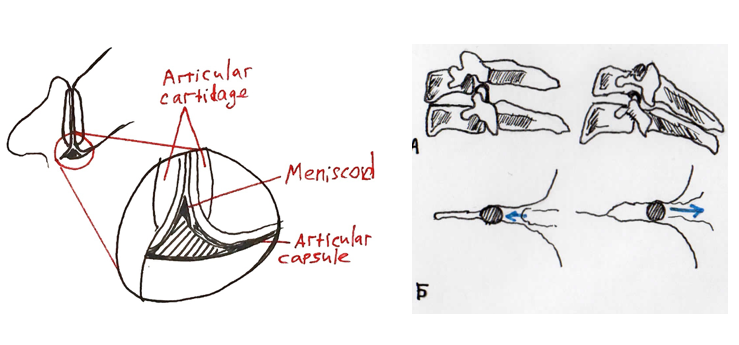 Положение и постулируемое заключение в менискоиды синовиального сустава А) Схема структурных компонентов менискоида в поясничном фасеточном суставе
B)Захват менискоидов в шейных фасеточных суставах, ограничивающий разгибательные и сгибательные движения
C)Захват менискоида в постулированном виде вызывает деформацию поверхности суставного хряща; после сокращения и со временем суставной хрящ претерпевает ремоделирование.