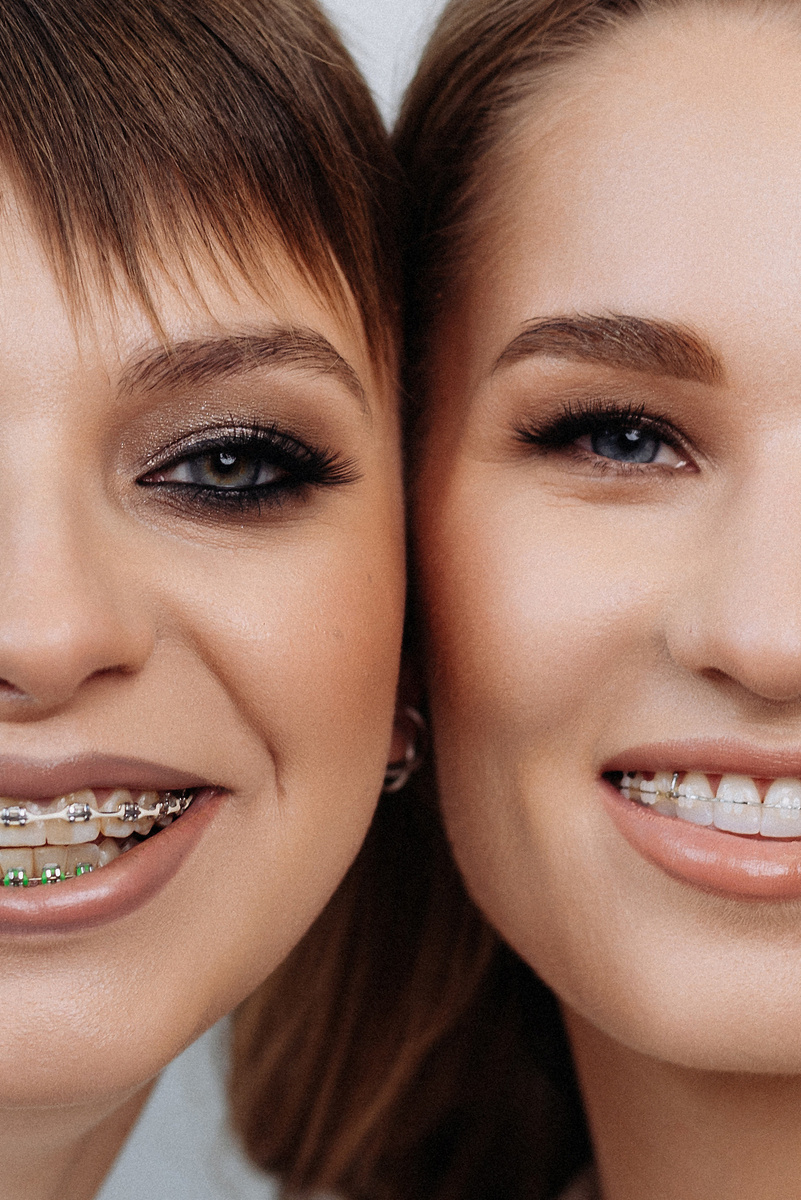 В ПРАЙМе работают с металлическими (слева) и керамическими (справа) брекет-системами, потому что они самые эффективные.