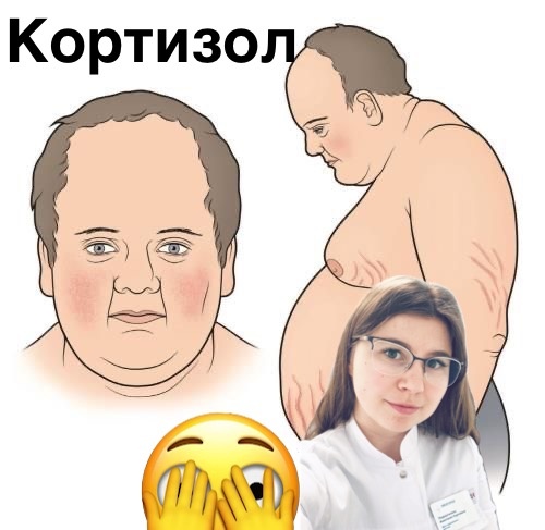 Иллюстрация пациента с повышенным уровнем кортизола из открытых источников. 