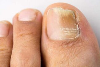 Грибок ногтей - подолог Долгопрудный